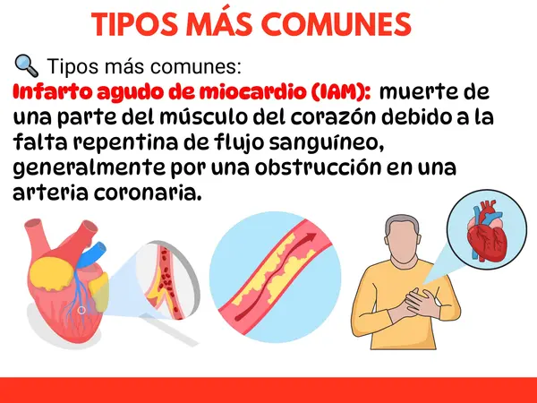 Prevención, detección y acción IAM - ACV
